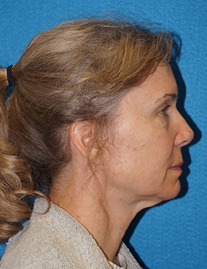 Facelift/Necklift