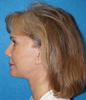 Facelift/Necklift