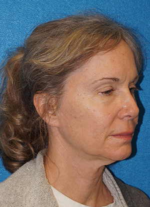 Facelift/Necklift