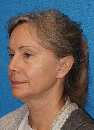 Facelift/Necklift