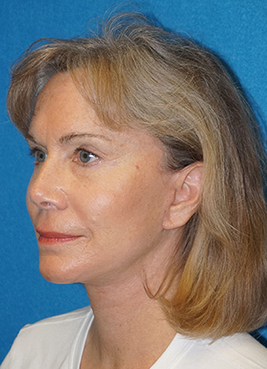 Facelift/Necklift