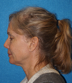 Facelift/Necklift