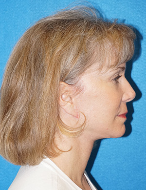 Facelift/Necklift