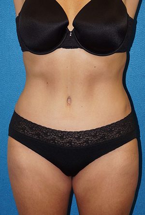 Tummy Tuck