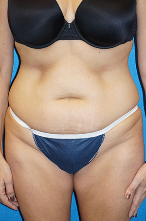 Tummy Tuck