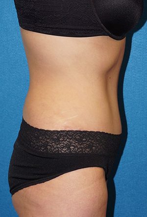 Tummy Tuck