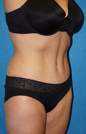 Tummy Tuck