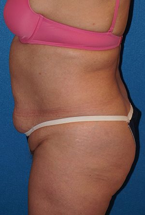 Tummy Tuck