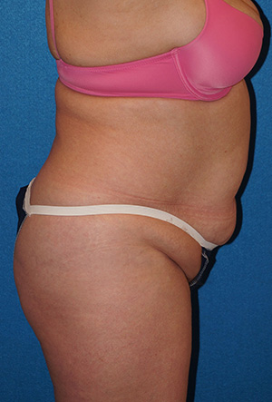 Tummy Tuck