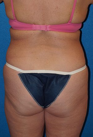 Tummy Tuck