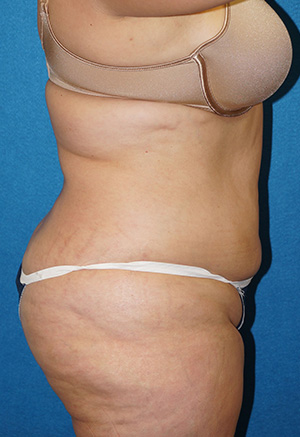 Tummy Tuck