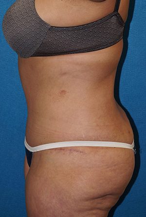 Tummy Tuck