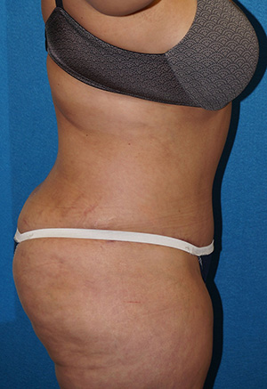 Tummy Tuck