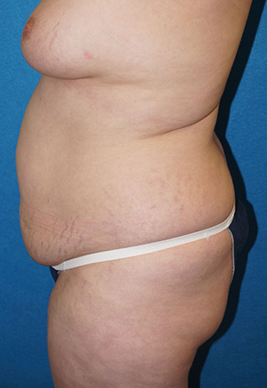 Tummy Tuck