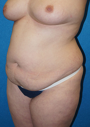 Tummy Tuck