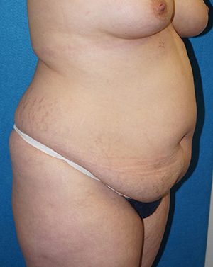 Tummy Tuck