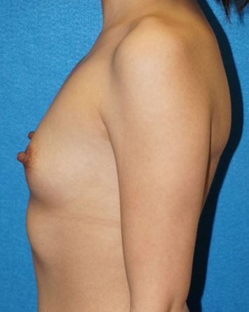 Breast Augmentation