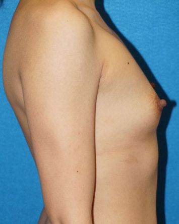 Breast Augmentation