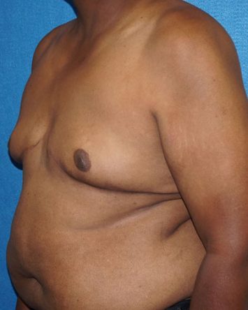 Male Breast Reduction