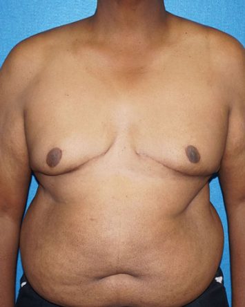 Male Breast Reduction