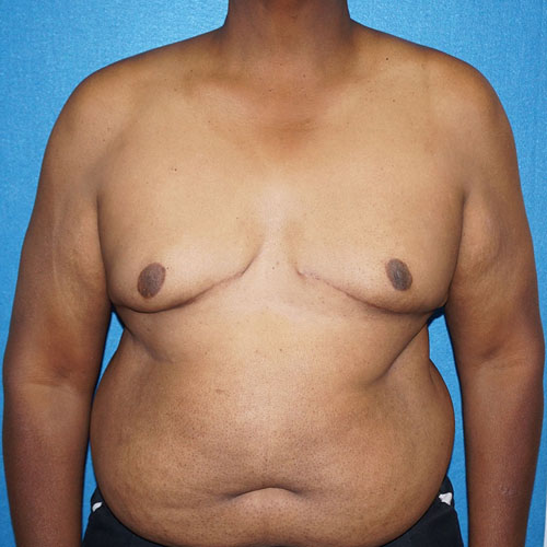 Male Breast Reduction