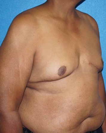 Male Breast Reduction