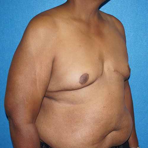 Male Breast Reduction