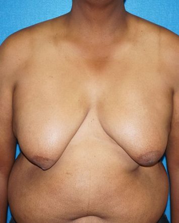 Male Breast Reduction