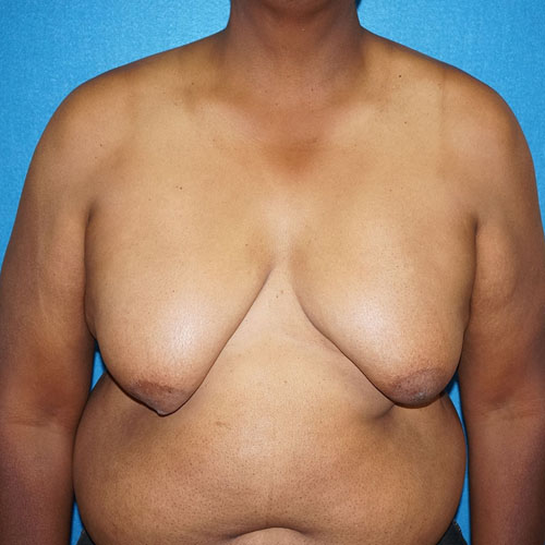 Male Breast Reduction