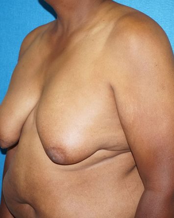 Male Breast Reduction