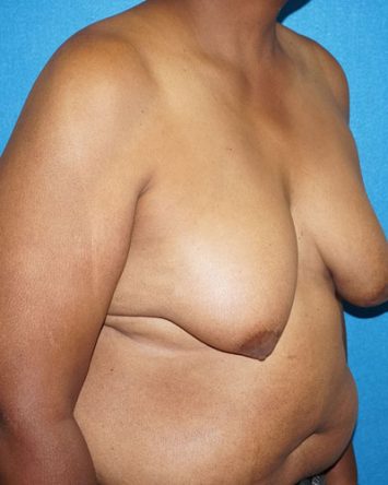 Male Breast Reduction