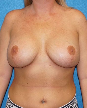 Breast Lift