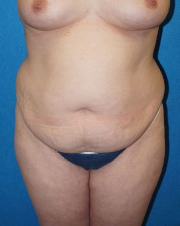 Tummy Tuck