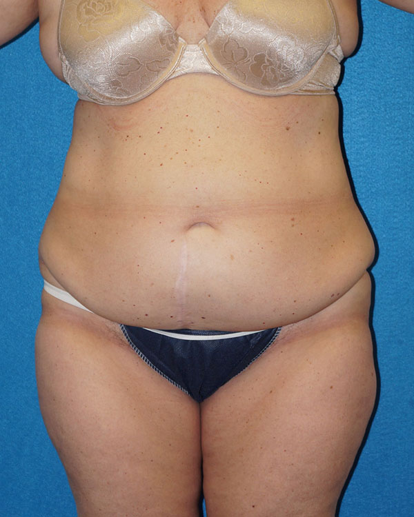 Tummy Tuck