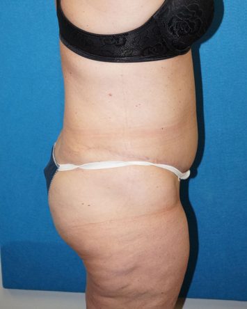 Tummy Tuck