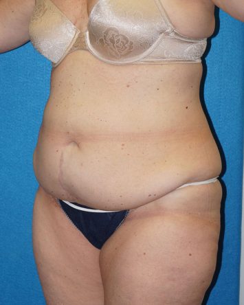 Tummy Tuck