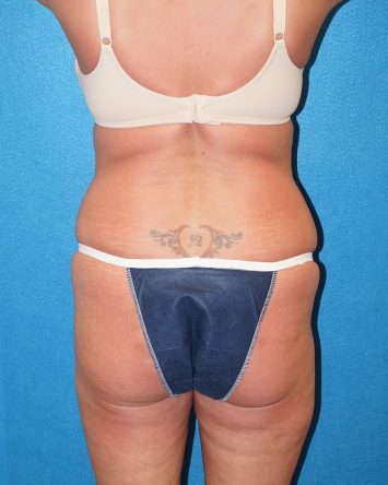 Tummy Tuck