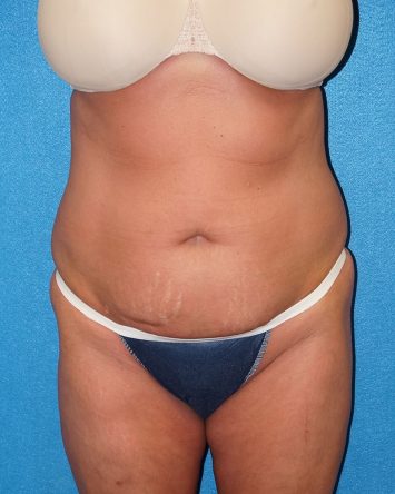 Tummy Tuck