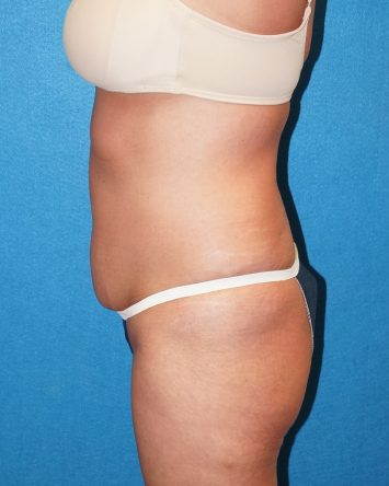 Tummy Tuck