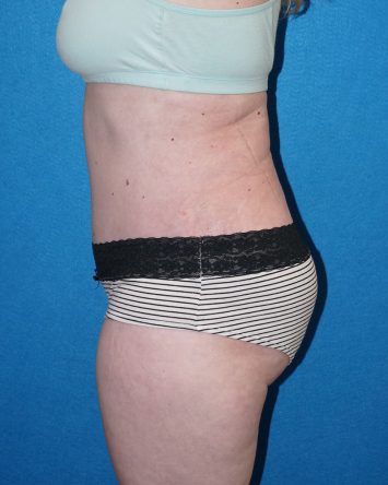 Tummy Tuck