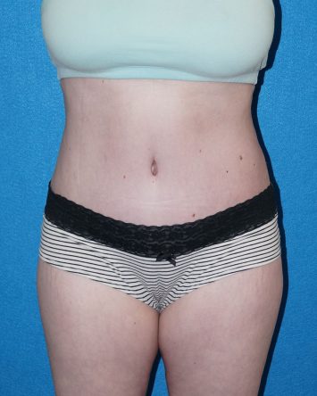 Tummy Tuck