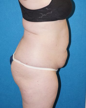 Tummy Tuck