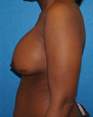 Breast Augmentation