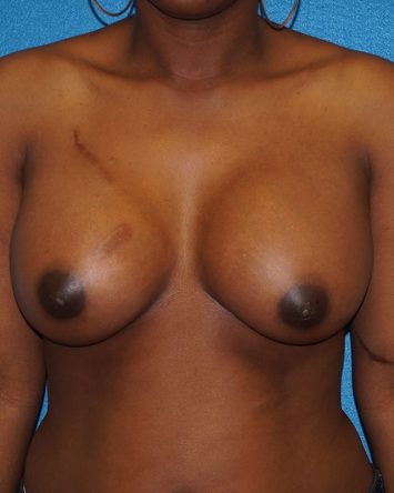 Breast Augmentation