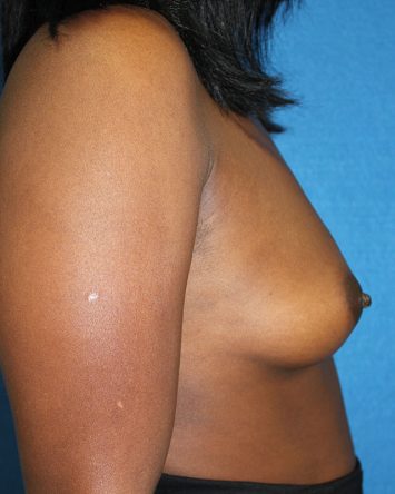 Breast Augmentation