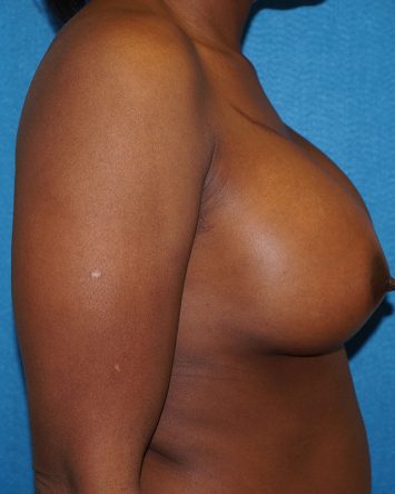 Breast Augmentation