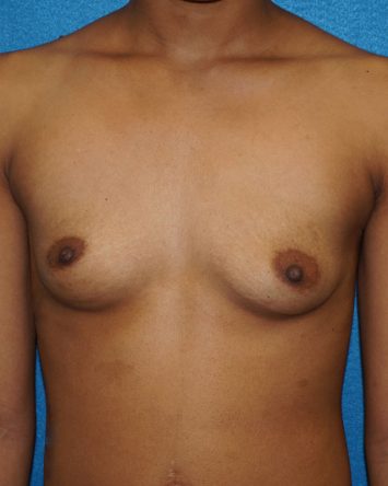 Breast Augmentation