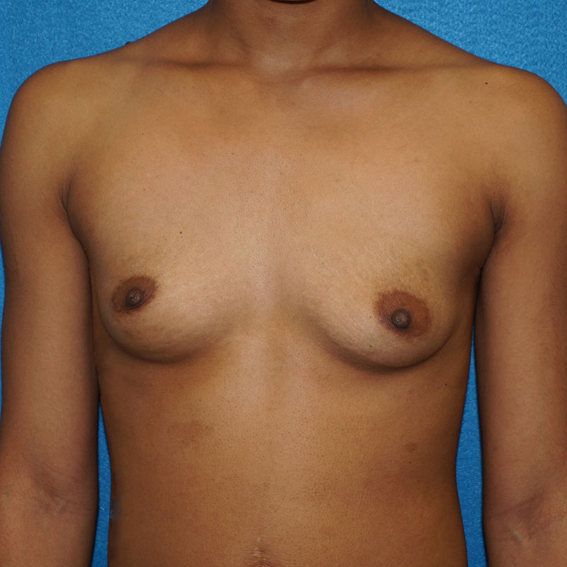 Breast Augmentation