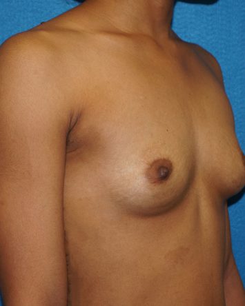 Breast Augmentation