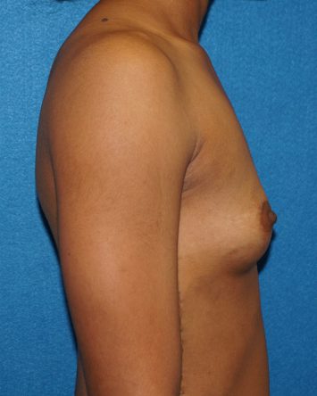 Breast Augmentation